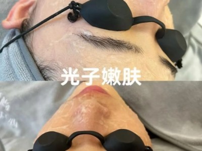30秒带你体验光子嫩肤过程