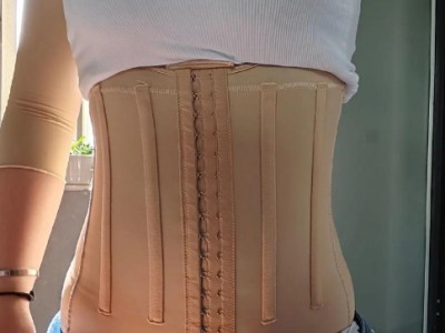 吸脂术后第十三天,恢复得还可以,状