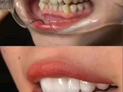牙齿美容提升生活