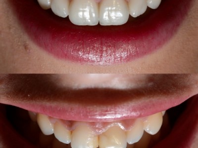 瓷贴面是如何让牙齿变白的